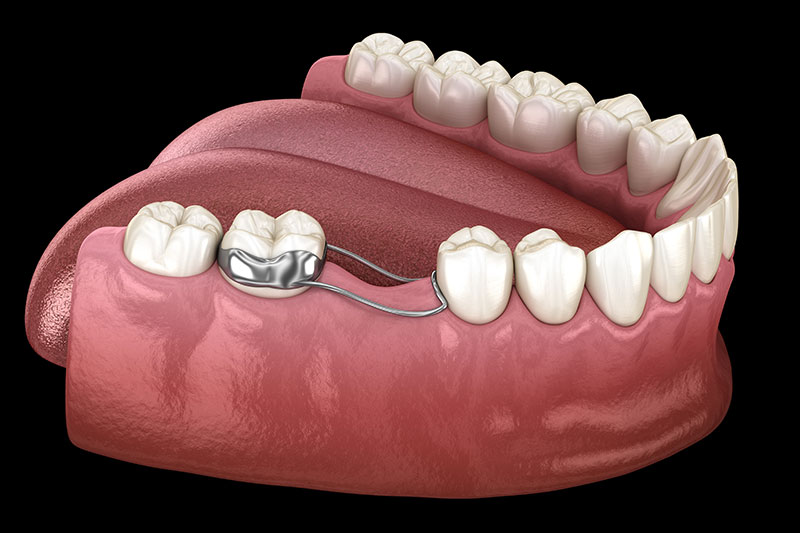 Dental Spacers in Fulshear