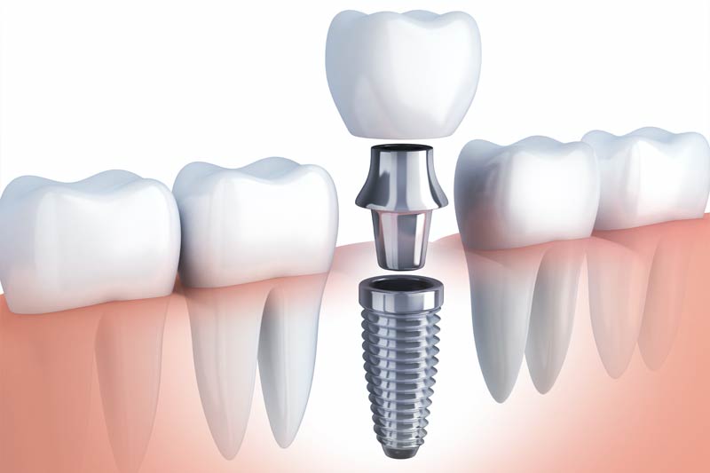 Implants Dentist in Fulshear